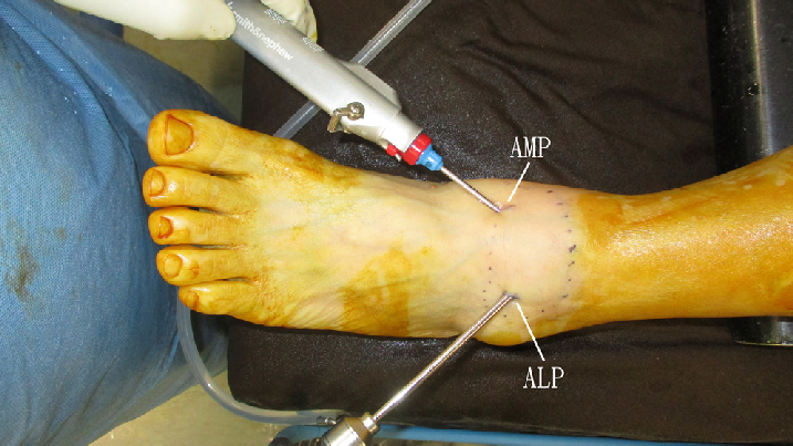 ACL Reconstruction surgery